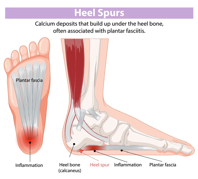 chematische weergave van hielspoor (fasciitis plantaris) met ontstoken peesplaat onder de hiel