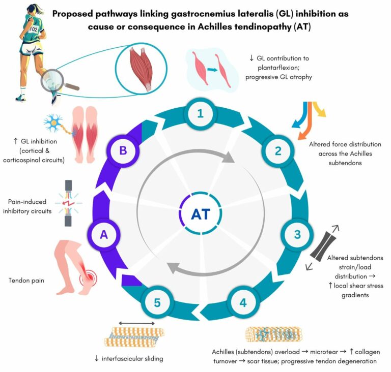 schematische weergave hoe achillespeesklachten kunnen ontstaan