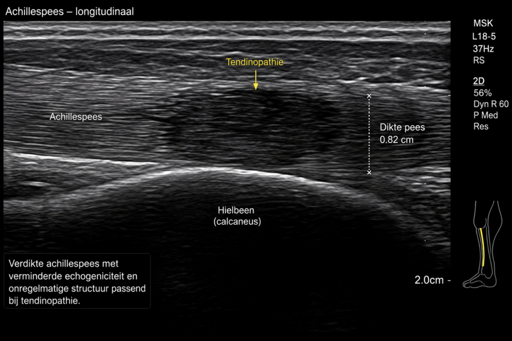 Echobeeld van een achillespees tendinopathie met verdikking van de pees en verminderde echogeniciteit.